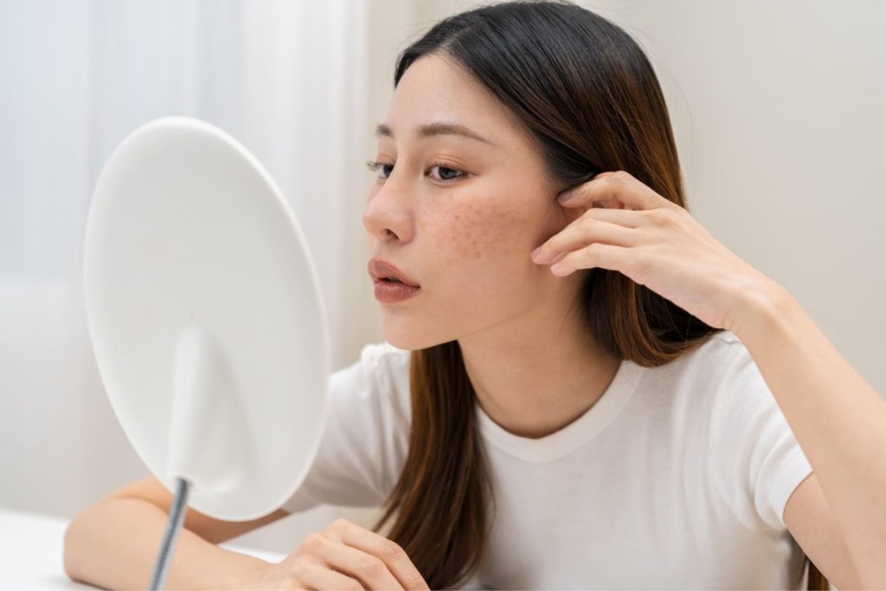 tratamento de melasma e peeling de porcelana
